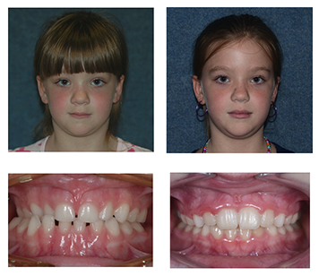 Two phase orthodontics