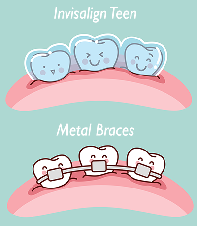 Invisalign teen or metal braces