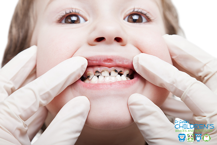 Cavities In Children