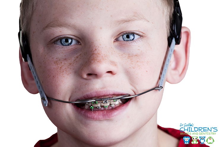 Severe Overbite San Diego